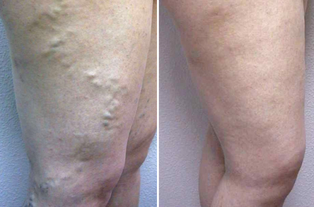 Y tratamiento de medicarelas varices